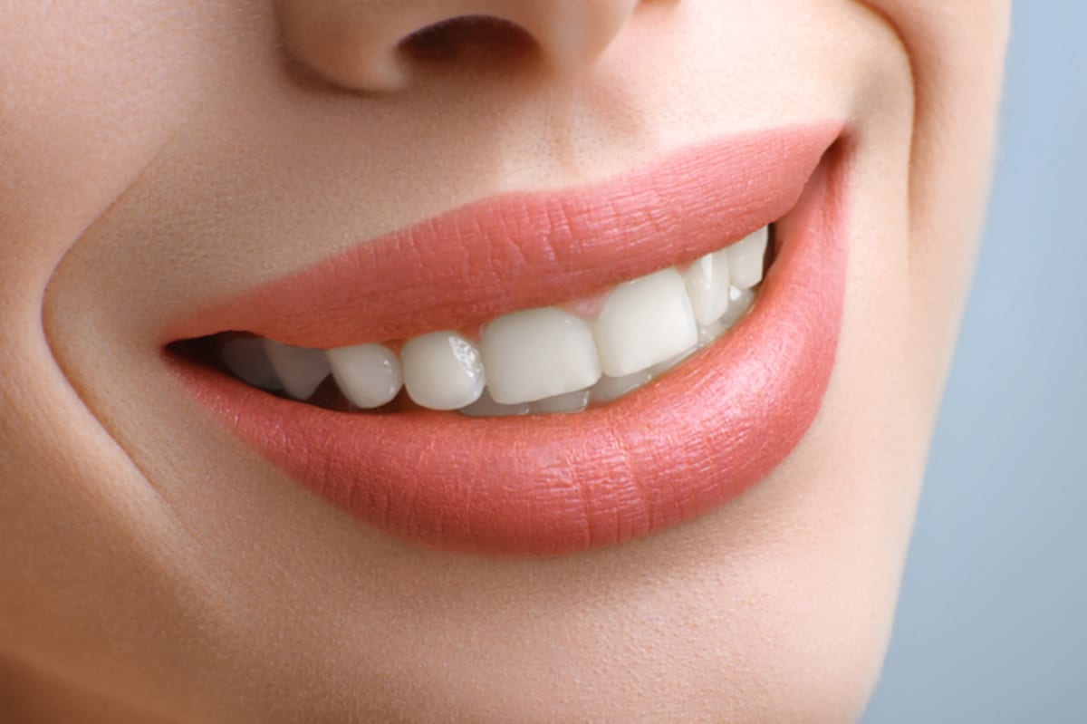 Teeth Whitening in Castle Hills