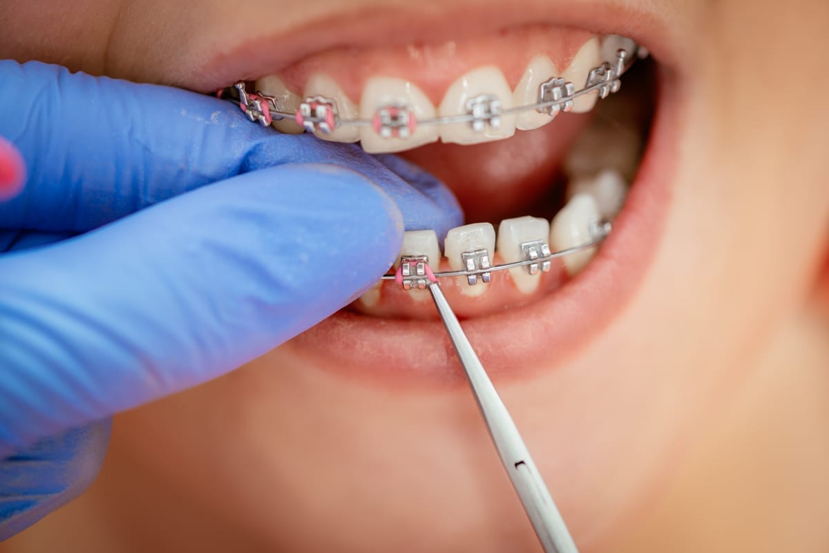 Full-Mouth Restoration in San Antonio