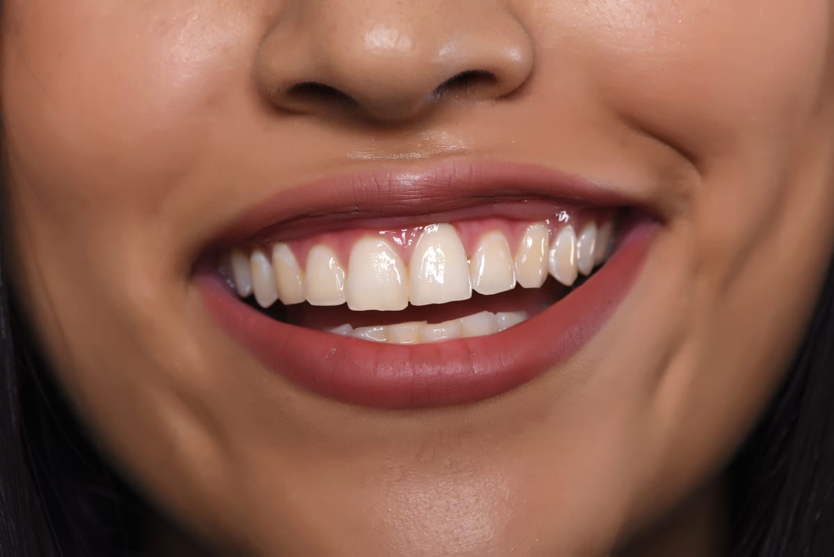 Gum Disease Treatment in San Antonio