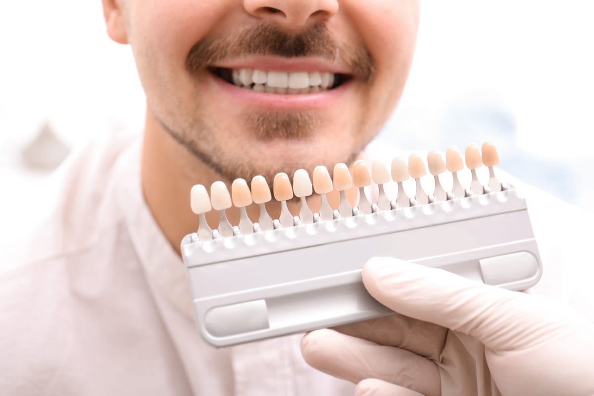 Veneers in Olmos Park